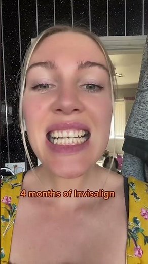 Invisalign before and after transformation