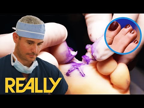 Patient Nearly Loses Toe In "Webbed Feet" Surgery | My Feet Are Killing Me