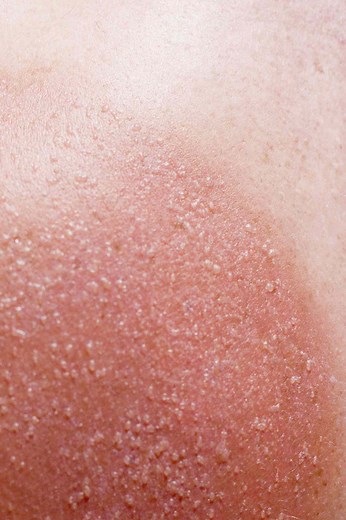 Sun Poisoning Symptoms To Know—and How To Treat Them