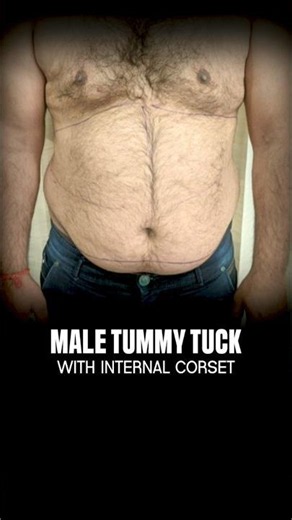 Male Tummy Tuck Transformation | Hanging Belly to Flat, Firm Abdomen