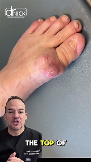 Most common arthritis in the foot