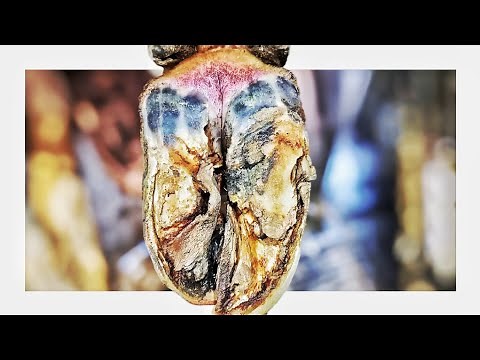 CARVING UP AN INFECTED COWS HOOF