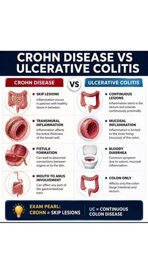 IBD crohn disease vs Ulcerative Colitis