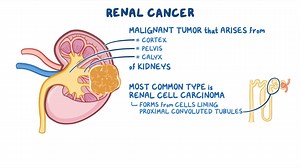 Video: Renal cancer: Nursing - Video Explanation! | Osmosis | Osmosis