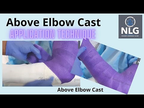 above elbow cast application // long arm cast