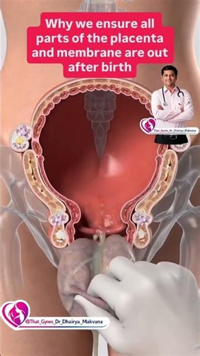 why to remove placenta #PostpartumCare#SafeDelivery#PlacentaCare #ThatGynecDrDhairyaMakvana 👶🏻🩺