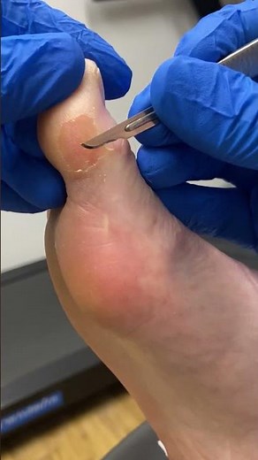 Satisfying Big Toe Callus Removal Unbelievable Transformation #CallusRemoval #FootCare