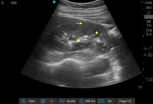Bedside Assessment of the Kidneys and Bladder Using Point of Care Ultrasound - POCUS Journal