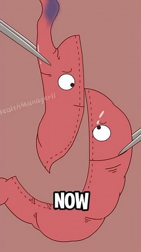 A damaged esophagus, repaired with the stomach? An incredible surgery.#shorts