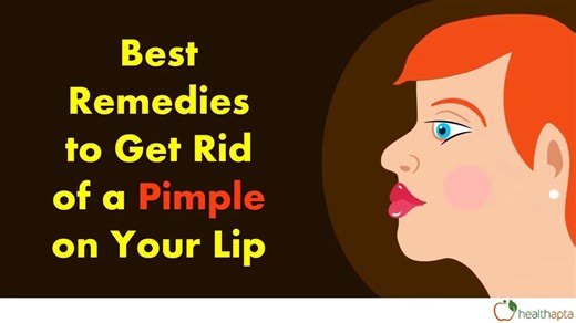 Best Remedies to Get Rid of a Pimple on Your Lip