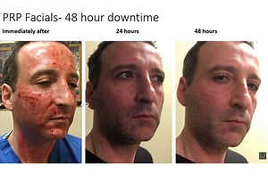 Microneedling Newburgh, NY | Hudson Valley | Dr. Rubinstein