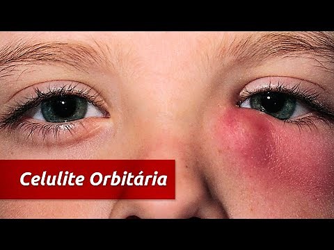 Celulite Orbitária - Dr. Bressan Oftalmologista