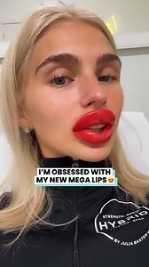 My new lips are perfect and so worth it 😍 | Ultimate