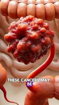 Colorectal Cancer Explained: Causes, Symptoms, Prevention & Screening. #colorectalcancer