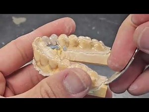 Make ESSIX retainer for #10 and #11