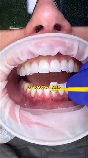 Are you interested in getting dental veneers? #dentalveneers #porcelain #resin