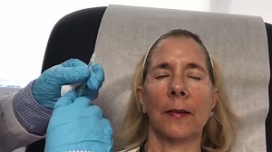 Botox Treatment Process and Results