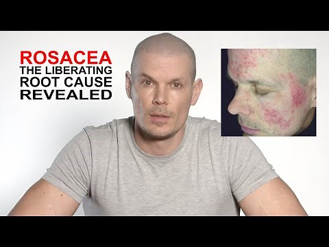 Rosacea, the liberating root cause revealed.