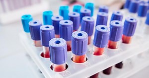 RDW - norma, morfologia, badanie krwi, czerwone krwinki. Czym jest zakres rozkładu objętości czerwonych krwinek?