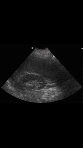 Radiology @all abnormalities 🥏🥏 | Clinical Presentation Abdominal pain and distension Dark (coffee-ground) vomiting No fever No clinical shock Patient Details Age: 90 years... | Instagram