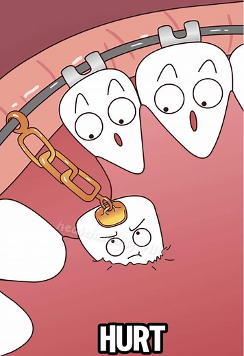 Understanding Impacted Wisdom Teeth and Their Removal