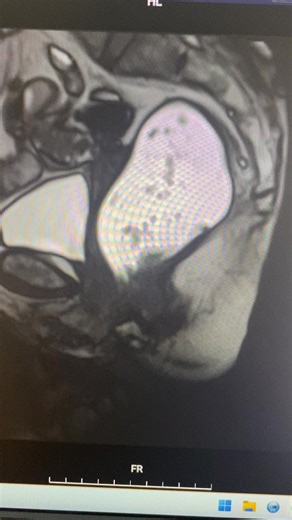 Mri động học sàn chậu | MRI Việt Sub