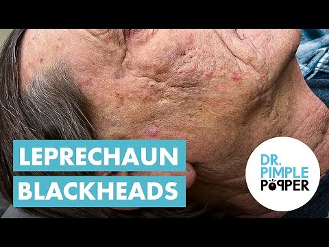 Blackhead, Blackheads, & Blackheads (Extended Leprechaun Blackheads)