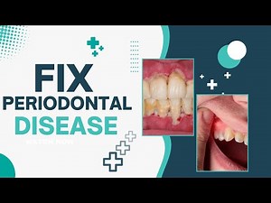 How to Reverse and Fix Periodontal Disease: 6 Effective Ways