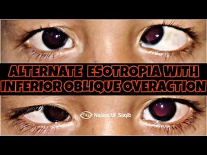 Squint/Strabismus Examination - Alternate Esotropia With Inferior Oblique Overaction
