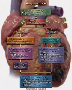 2.7K views · 95 reactions | A detailed flowchart for the management of ST-elevation myocardial infarction (STEMI). #STEMI #Cardiology #HeartAttack #ACLS #EmergencyMedicine #MedEd #CardioEd #FOAMed #ECG #MI #PCI #CathLab | Abdallah Othman | Facebook