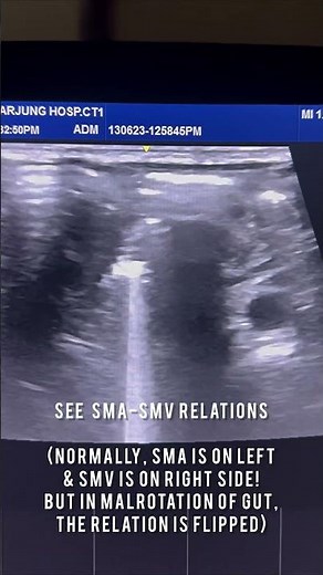 Midgut volvulus with malrotation of gut #ultrasound #radiology #emergency #neetpg #paediatrics