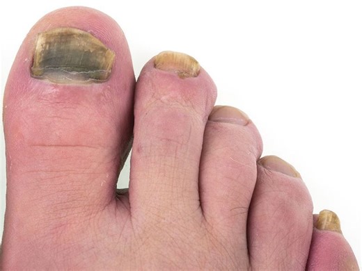 icd 10 toenail fungus - Toenail Fungus Treatment | Toenail Fungus Treatment