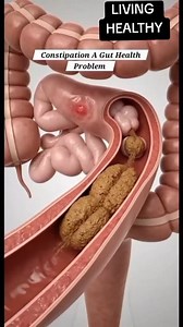 this remedy will help in relieving constipation | Living Healthy