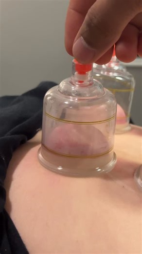 Dr. Parth S Sharma | Alternative Healthcare Specialist on Instagram: "🏆What is Cupping Therapy? ⚫️Cupping therapy involves placing cups on the skin to create suction, which lifts the muscle and fascia, promoting blood flow, reducing inflammation, and releasing deep-seated tension. ⚫️How it works: The suction created by the cups helps to release tight muscles, increase mobility, and improve recovery. It’s perfect for breaking up scar tissue or relieving soreness after a hard workout or co