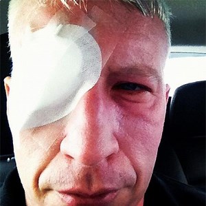 Anderson Cooper, eyeball blinded by the sun, rocks an eye patch - UPI.com