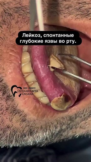 What are Leukemia mouth sores? A thread 👇