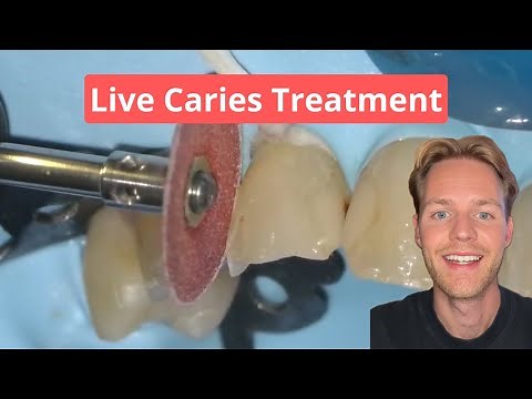 Fixing a Cavity in a Front Tooth: Step-by-Step Dental Treatment Explained
