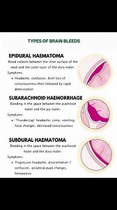 74K views · 522 reactions | Types of brain bleeds #viralreelschallenge #medicalstudent #diseases | Surgi Cal Tec | Facebook