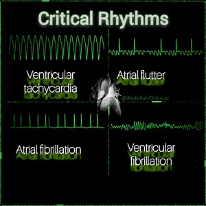 🚨 Master the Essentials: 4 Critical Rhythms You Must Know. VT, AFl, AFib, VF — recognizing these can save a life. Know the hallmarks. Know the actions. ▶️VT: Wide complex, AV dissociation. Unstable? Cardiovert. ▶️AFl: Sawtooth waves. Rate control anticoagulate. ▶️AFib: Irregularly irregular. Stroke prevention is paramount. ▶️VF: Chaotic waveform. Defibrillate immediately. Repost ♻️ to spread the knowledge. Repost to educate your network. Drop your #1 rhythm tip in the comments! 👇 #Cardiology #