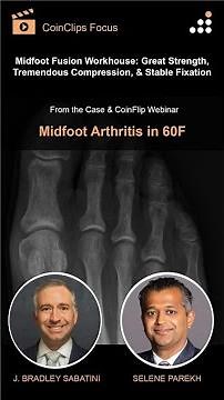 Enhanced Compression in Midfoot Fusion with NeoSpan Compression Implant System