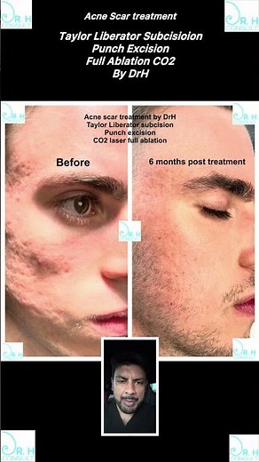 Acne scar subcision and resurfacing explanation video