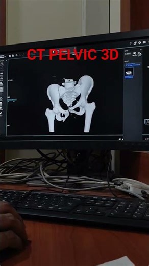 CT PELVIC 3D FRACTURE #anatomy #motivationalvideo #radiologytechnologist