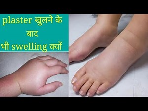 what is the reason of swelling after plaster (plaster खोलने के बाद भी swelling का क्या कारण है।।)