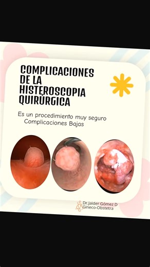 🪷Surgical hysteroscopy (SH) is a minimally invasive, versatile procedure that provides easy access to the uterine cavity. 🪷It is the preferred procedure for the resection, ablation, and removal of submucosal fibroids, septa, polyps, biopsies, bone metaplasia, and scar or niche defects. 🪷In SH, bipolar energy and 0.9% saline solution are used, reducing the risk of burns and improving visibility and drainage of the solution. 🪷Complications of SH depend on the complexity of the tumor (size, vas
