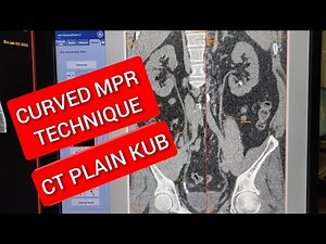 Curved MPR Protocol for CT Plain KUB.