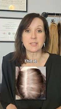 Telogen Effluvium Explained