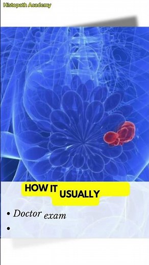 Fibroadenoma: Symptoms, Causes & Treatment