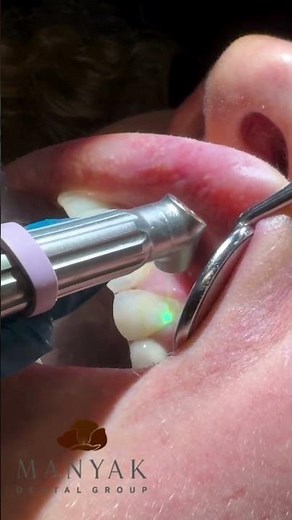 Stress-Free Decay Removal with the Solea Laser | Dr. Manyak, Manyak Dental Group