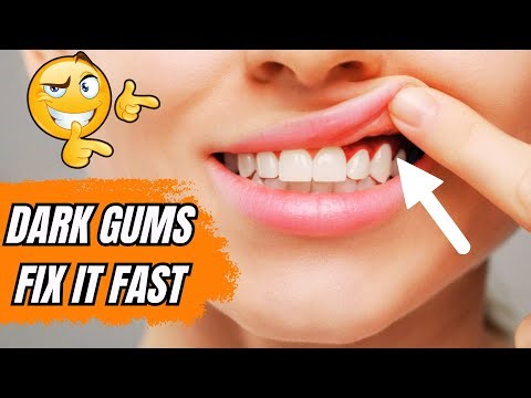 How to Fix of Dark Gums Naturally (Dentist-Recommended Remedies)