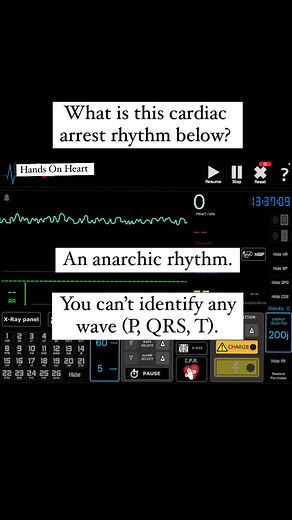 The four Cardiac Arrest Rhythms: Ventricular Fibrillation ; Pulseless Ventricular Tachycardia; Pulseless Electrical Activity and Asystole #ecg #ekg #acls #ahaacls #nclex #nclexquestions #arrhythmia #handsonheart #nurselife #nursingschool #nursesnyc #nclexprep #medicalstudent #pa #physicians #ahaacls #ventricularfibrillation #ventriculartachycardia #pulselesselectricalactivity #pea #pulselessventriculartachycardia #cardiacarrest #vfib
